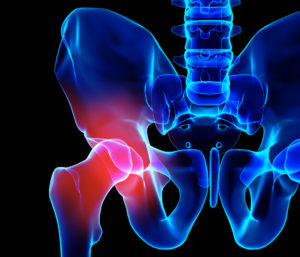 physical therapy for hip dysplasia