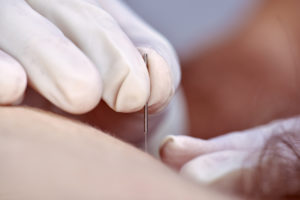 benefits of dry needling